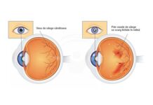 Retinopatia diabetică: ce este și cum să o combatem