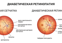 Диабетическая ретинопатия: что это и как с ней бороться